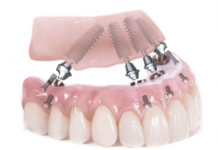 Phương pháp trồng răng Implant toàn hàm: All on 4