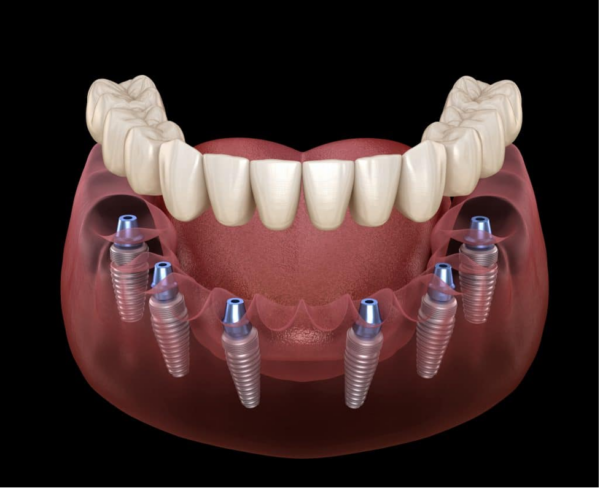 Phương pháp trồng răng Implant toàn hàm: All on 6