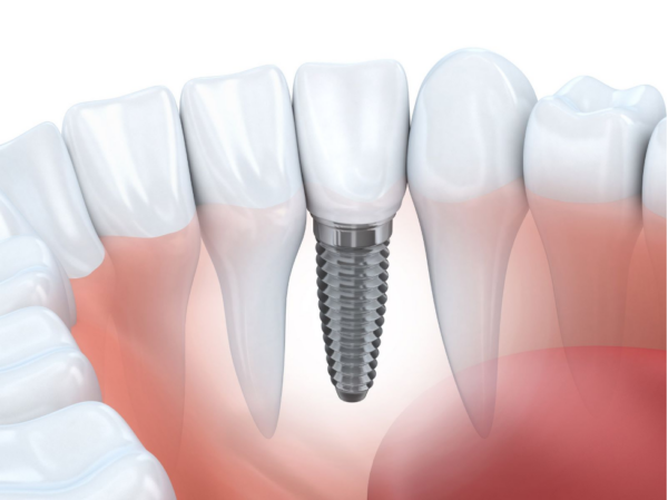 Giới thiệu phương pháp trồng răng Implant toàn hàm