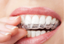 Niềng răng trong suốt là phương pháp hiện đại nhất để chữa móm răng