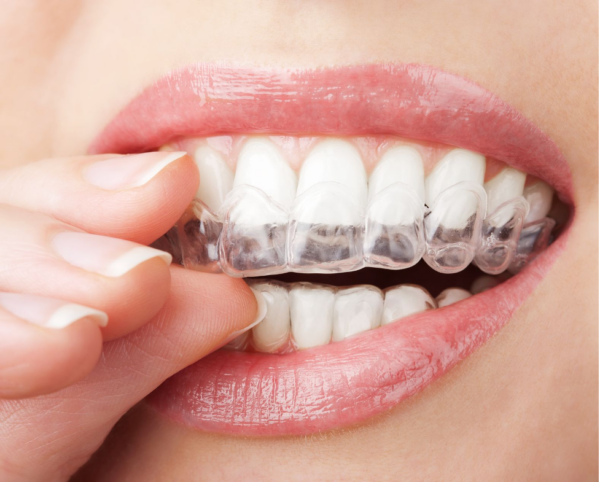 Niềng răng trong suốt là phương pháp hiện đại nhất để chữa móm răng