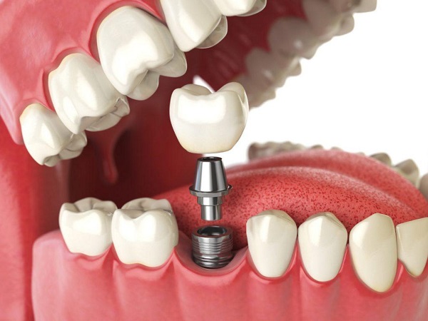 thời gian trồng răng implant