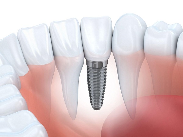 thực hiện trồng răng implant với bác sĩ uy tín