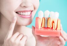 trồng răng implant thay thế cho răng đã mất