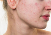 cách trị thâm đỏ sau mụn