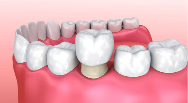 Phương pháp bọc sứ giúp khắc phục nhược điểm của răng hiệu quả