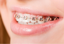 Phương pháp niềng răng hay bọc sứ luôn được nhiều người cân nhắc khi lựa chọn