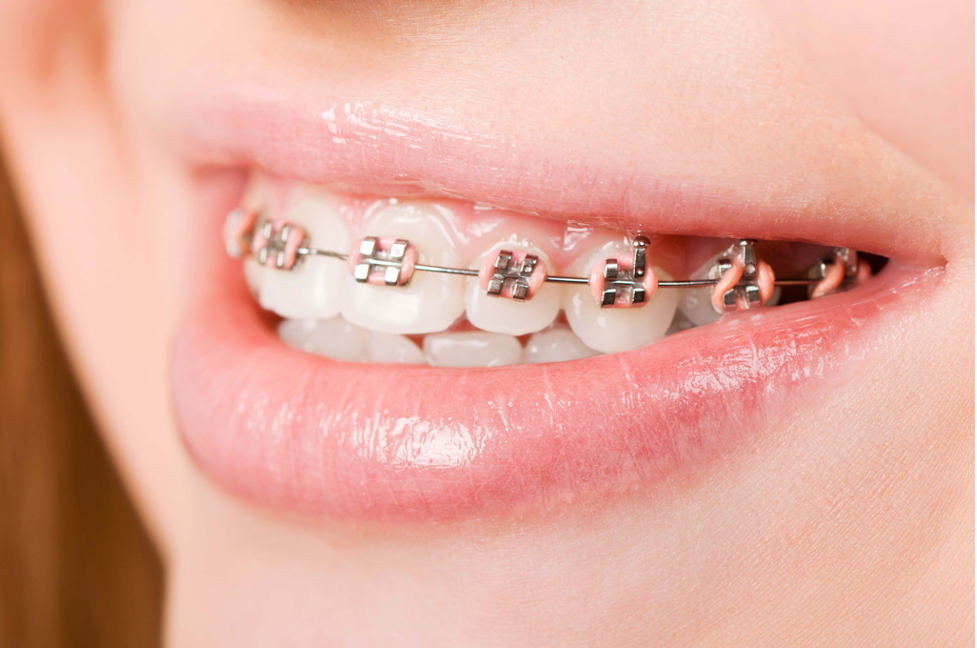 Phương pháp niềng răng hay bọc sứ luôn được nhiều người cân nhắc khi lựa chọn