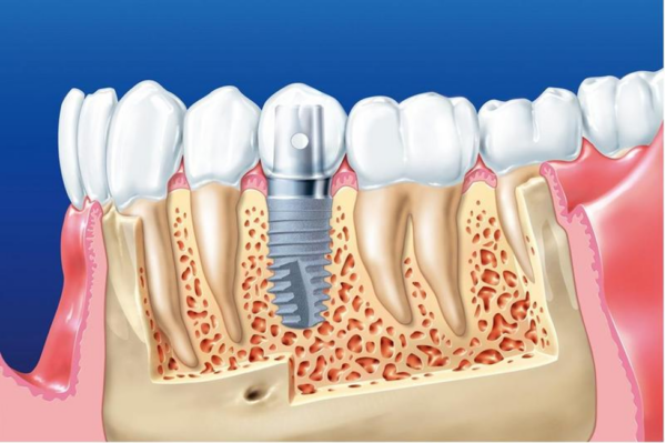 Trồng răng implant nguy hiểm không là sự trăn trở của nhiều người khi thực hiện phương pháp này
