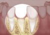 Mất răng bao lâu thì bị tiêu xương hàm?