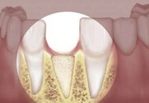 Mất răng bao lâu thì bị tiêu xương hàm?