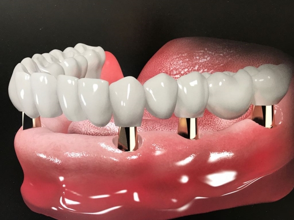 Trồng răng nguyên hàm