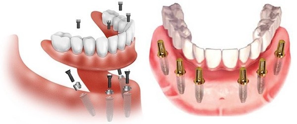 Trồng răng Implant toàn hàm