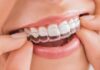Niềng răng Invisalign