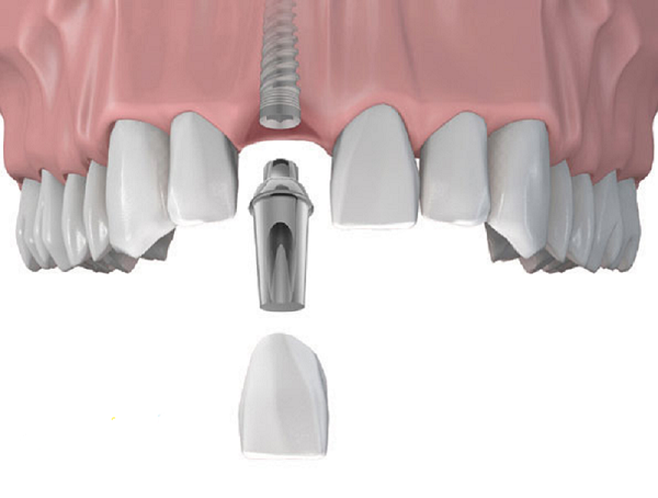 Trồng Implant răng cửa