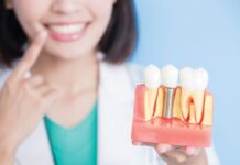 cấy ghép Implant nha khoa