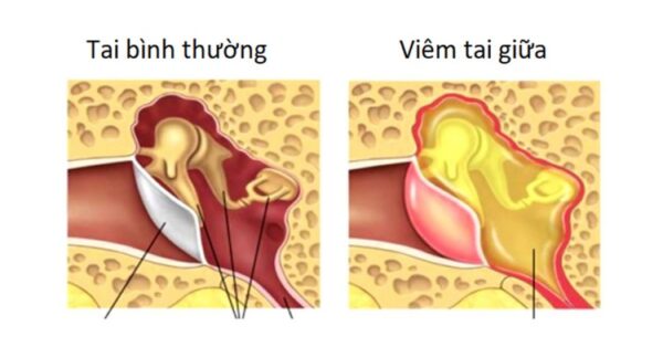 các bệnh thường gặp ở trẻ em