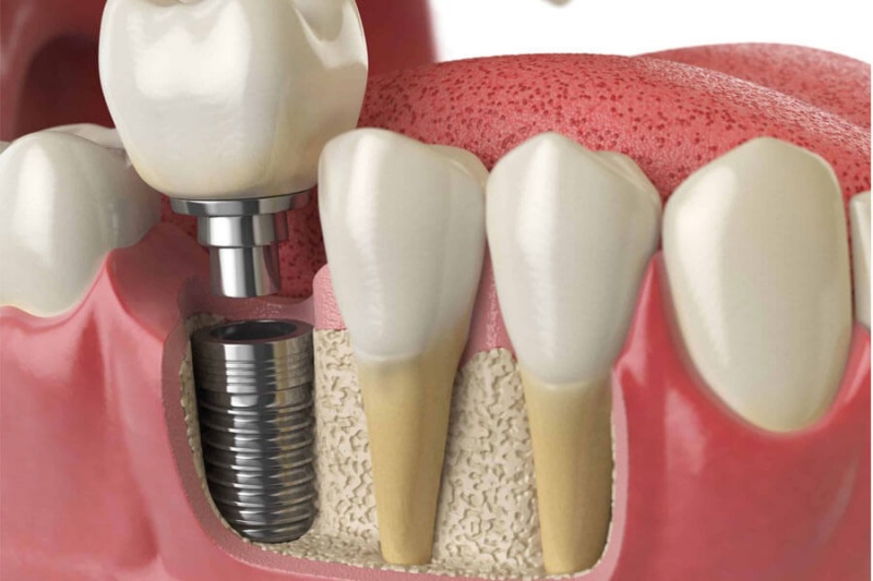 nhổ răng bao lâu thì cấy implant