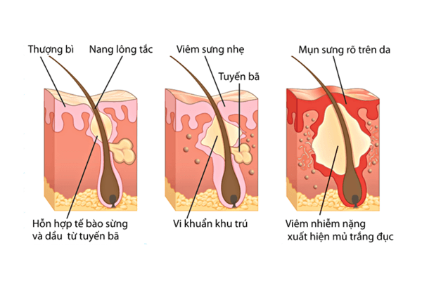 Cơ chế hình thành mụn bọc