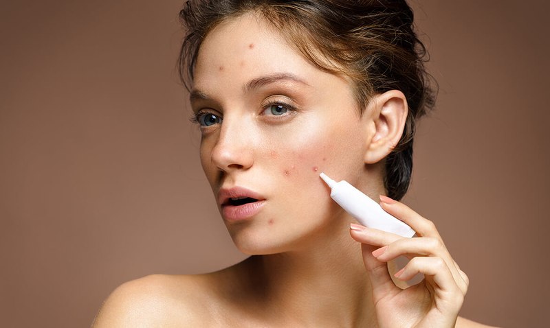 Cách gom cồi mụn nhanh bằng mỹ phẩm
