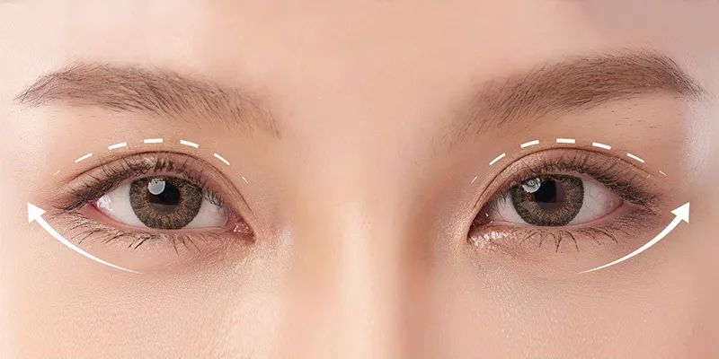 ghép da khi cắt mí dưới bị lật