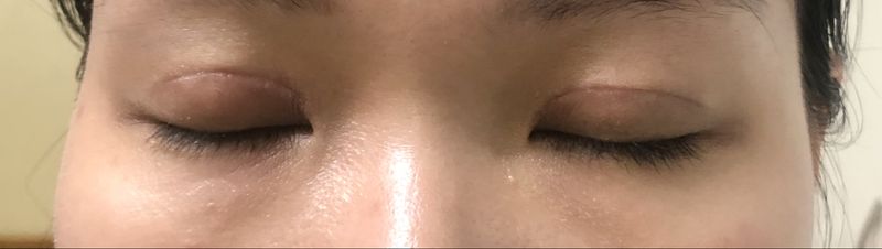Nhấn mí bị lệch phải làm sao