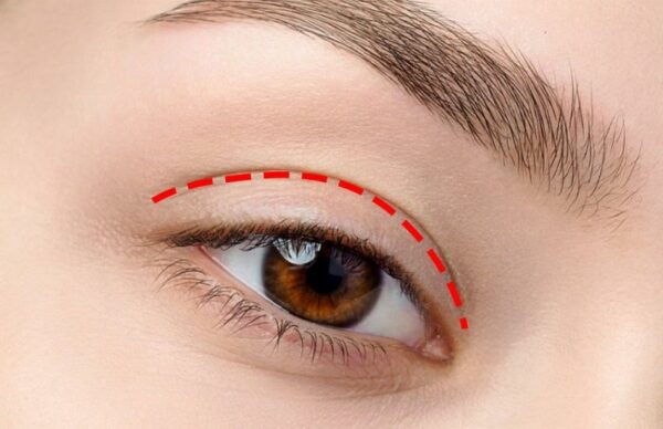 nhấn mí bị lệch