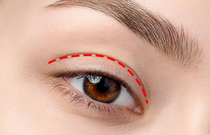 nhấn mí bị lệch