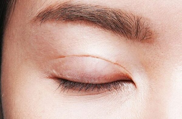 nhấn mí hỏng có sửa được không